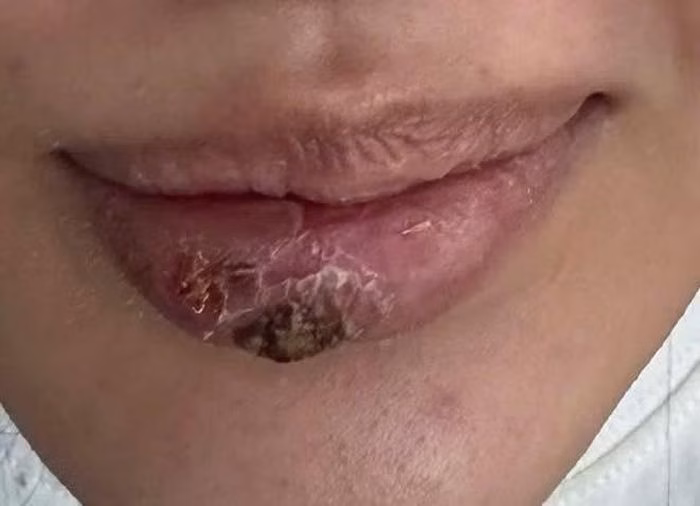 Bệnh nhân đã hồi phục và xuất viện sau quá trình điều trị tích cực tại Bệnh viện Bạch Mai. Ảnh nguồn: bachmai.gov.vn